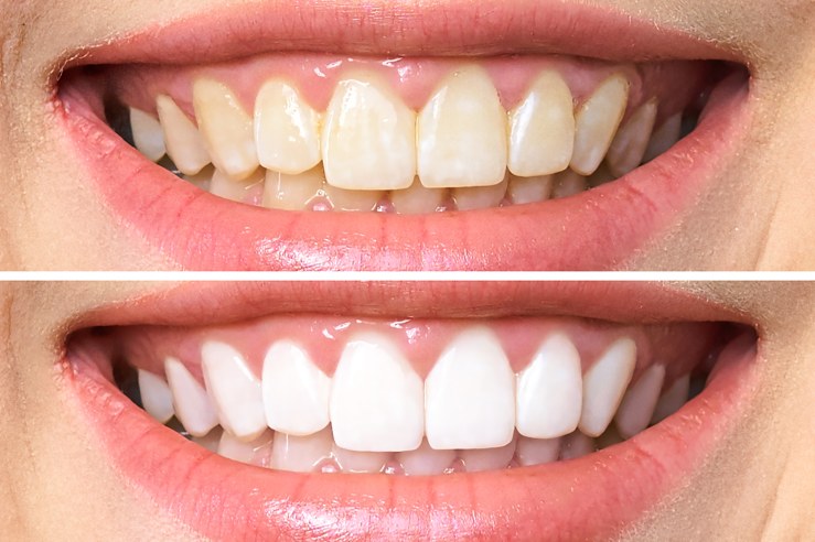 Dentist Teeth Before After Picture Procedure Sample